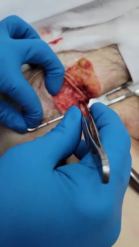 Unbelievable Blood Clots Video From Embalmer Richard Hirschm Newtube